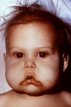 240px-Kwashiorkor_6180.jpg